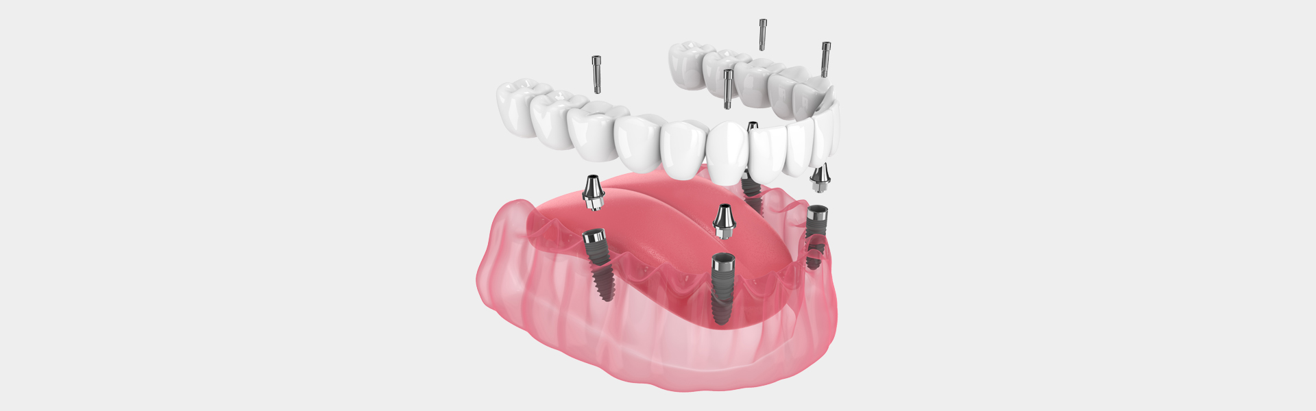All-on-4 Implants