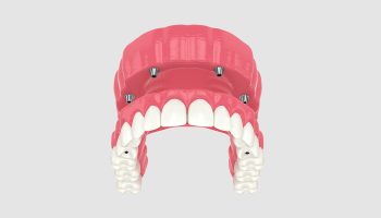 How All-on-4 Implants Preserve Jawbone Health Compared to Dentures