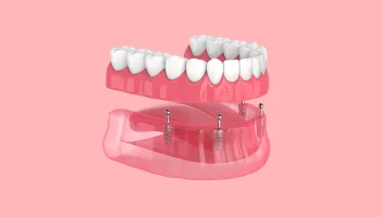 Everything You Should Know About All-On-4 Dental Implants