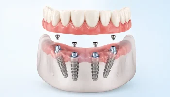 All-on-4 Implants in Atlanta: A Long-Term Solution for Missing Teeth